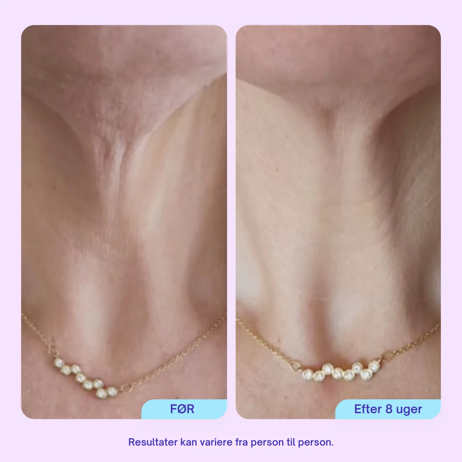 NeckLift™ Firming Cream – Opstrammende Halscreme Mod Slap Hud & Dobbelthage