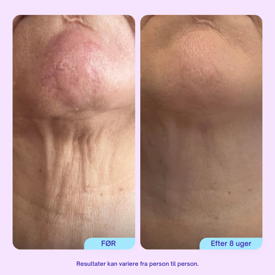 NeckLift™ Firming Cream – Opstrammende Halscreme Mod Slap Hud & Dobbelthage