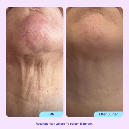 NeckLift™ Firming Cream – Opstrammende Halscreme Mod Slap Hud & Dobbelthage