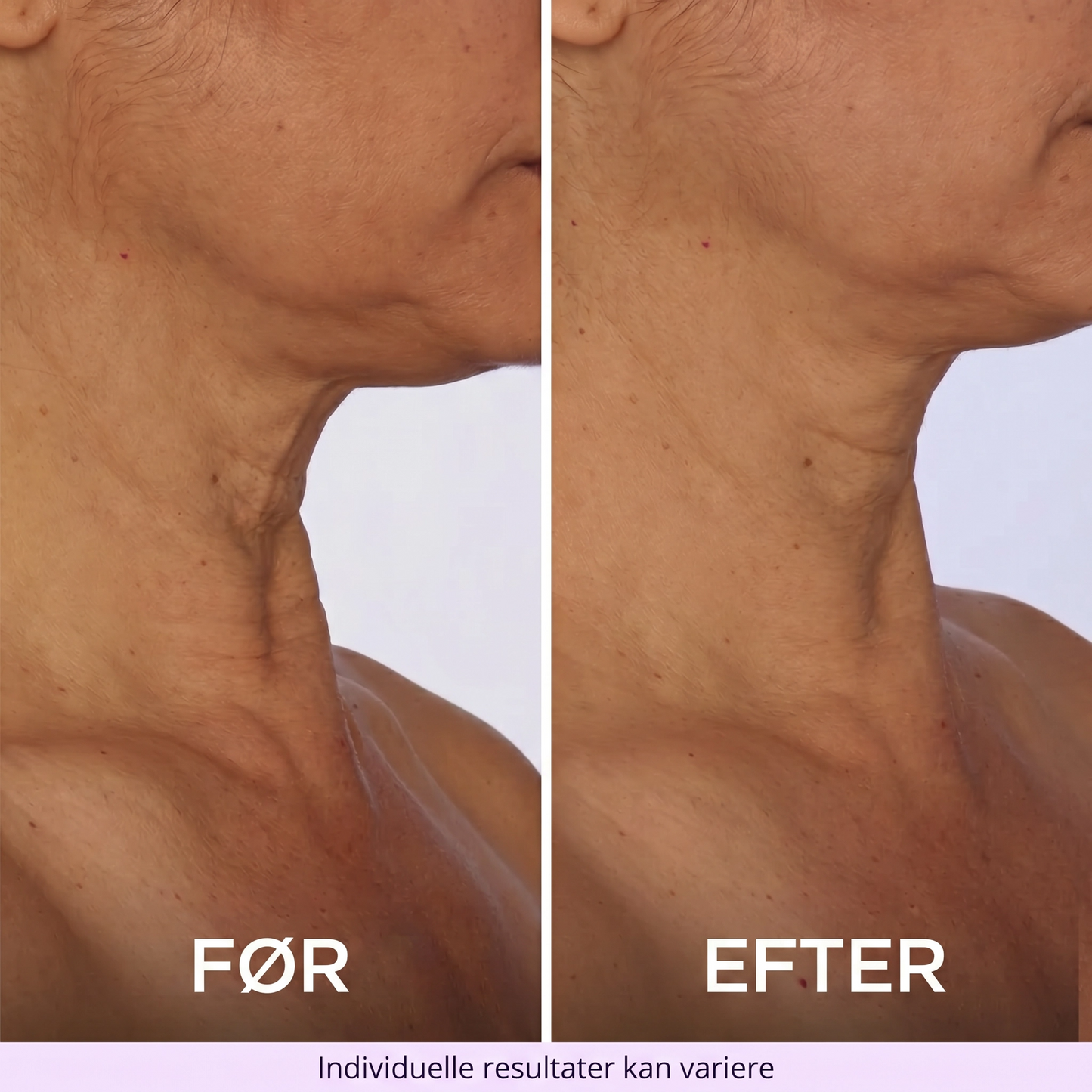 NeckLift™ Firming Cream – Opstrammende Halscreme Mod Slap Hud & Dobbelthage
